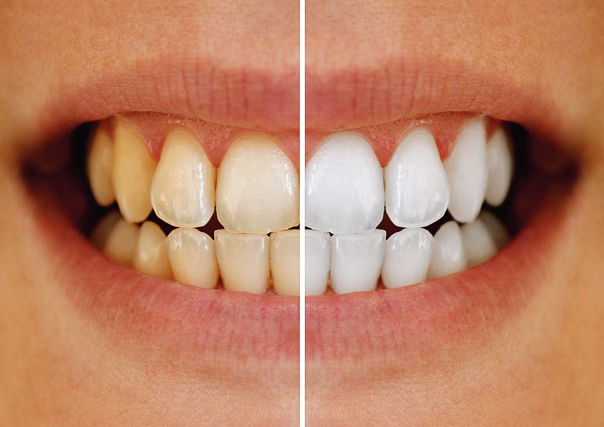 teeth whitening. 